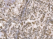 JUN Antibody Renal Clear Cell Carcinoma IHC. Immunohistochemical staining of FFPE human renal clear cell carcinoma tissue using JUN Antibody demonstrates strong nuclear HRP-DAB brown staining throughout neoplastic cell populations. The staining pattern is consistent with expression of JUN (c-Jun), a DNA-binding component of the AP-1 transcription factor complex that regulates gene expression involved in cellular proliferation, differentiation, stress responses, and signal-dependent transcriptional programs. The prominent nuclear localization observed within tumor cells is characteristic of an active transcription factor and supports the role of JUN in coordinating gene regulatory networks that influence cellular adaptation and tissue remodeling. HIER: boil tissue sections in pH 8 EDTA buffer for 20 minutes and allow to cool before testing.