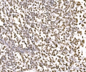 JUN Antibody Human Pancreatic Cancer IHC. Immunohistochemical staining of FFPE human pancreatic cancer tissue using JUN Antibody demonstrates extensive nuclear HRP-DAB brown staining throughout malignant epithelial cell populations. The staining pattern is consistent with expression of JUN (c-Jun), a DNA-binding component of the AP-1 transcription factor complex that regulates gene expression involved in cellular proliferation, differentiation, stress responses, and signal-dependent transcriptional regulation. The predominantly nuclear localization observed within tumor cells is characteristic of a transcription factor actively engaged in gene regulatory processes and supports the role of JUN in coordinating transcriptional networks associated with cellular adaptation and tumor biology. HIER: boil tissue sections in pH 8 EDTA buffer for 20 minutes and allow to cool before testing.
