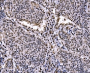 JUN Antibody Human Lung Cancer IHC. Immunohistochemical staining of FFPE human lung cancer tissue using JUN Antibody demonstrates widespread nuclear HRP-DAB brown staining throughout malignant tumor cell populations. The staining pattern is consistent with expression of JUN (c-Jun), a DNA-binding component of the AP-1 transcription factor complex that regulates gene expression involved in cellular proliferation, differentiation, stress responses, and signal-dependent transcriptional programs. The strong nuclear localization observed across neoplastic cells is characteristic of a transcription factor and supports the role of JUN in coordinating gene regulatory networks that influence cellular adaptation, growth, and tumor-associated signaling. HIER: boil tissue sections in pH 8 EDTA buffer for 20 minutes and allow to cool before testing.