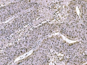 JUN Antibody Human Liver Cancer IHC. Immunohistochemical staining of FFPE human liver cancer tissue using JUN Antibody demonstrates widespread nuclear HRP-DAB brown staining throughout malignant hepatocellular populations. The staining pattern is consistent with expression of JUN (c-Jun), a DNA-binding component of the AP-1 transcription factor complex that regulates gene expression involved in cellular proliferation, differentiation, stress responses, and signal-dependent transcriptional regulation. The predominantly nuclear localization observed within tumor cells is characteristic of an active transcription factor and supports the role of JUN in coordinating gene regulatory networks that govern cellular adaptation, growth control, and tissue remodeling. HIER: boil tissue sections in pH 8 EDTA buffer for 20 minutes and allow to cool before testing.