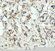 IHC staining of FFPE human breast cancer tissue with HGPRTase antibody, HRP-secondary and DAB substrate. HIER: boil tissue sections in pH8 EDTA for 20 min and allow to cool before testing.