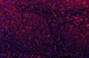 Immunofluorescent staining of FFPE human esophagus squama cancer tissue with PLD6 antibody (red) and DAPI nuclear stain (blue). HIER: steam section in pH6 citrate buffer for 20 min.