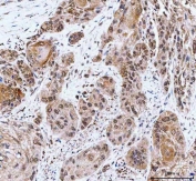 IHC staining of FFPE human esophageal squamous carcinoma tissue with CBP80 antibody. HIER: boil tissue sections in pH8 EDTA for 20 min and allow to cool before testing.