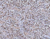 PYCARD Antibody / Inflammasome Adaptor Protein Antibody Human Glioblastoma IHC. Immunohistochemical staining of FFPE human glioblastoma tissue using PYCARD Antibody / Inflammasome Adaptor Protein Antibody. PYCARD expression is detected predominantly within the cytoplasm of tumor cells, consistent with its role as a central adaptor protein in inflammasome assembly and innate immune signaling. Heat-induced epitope retrieval was performed by boiling tissue sections in pH 8 EDTA buffer for 20 minutes and allowing them to cool prior to immunostaining.