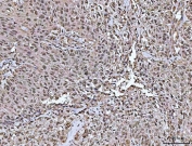 PYCARD Antibody / Inflammasome Adaptor Protein Antibody Human Urothelial Carcinoma IHC. Immunohistochemical staining of FFPE human urothelial carcinoma with squamous differentiation using PYCARD Antibody / Inflammasome Adaptor Protein Antibody. PYCARD expression is observed predominantly within the cytoplasm of neoplastic cells, consistent with its established role as an inflammasome adaptor protein involved in innate immune signaling, inflammatory responses, and pyroptotic cell death. Heat-induced epitope retrieval was performed by boiling tissue sections in pH 8 EDTA buffer for 20 minutes and allowing them to cool prior to immunostaining.