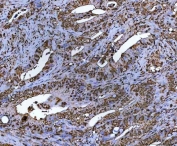 NR5A2 Antibody Colorectal Cancer IHC. Immunohistochemistry staining of FFPE human colorectal adenocarcinoma tissue using NR5A2 antibody demonstrates prominent nuclear and cytoplasmic HRP-DAB brown staining within malignant gland-forming epithelial cells and infiltrative tumor-associated structures. The observed staining profile is consistent with expression of NR5A2 / Liver receptor homolog 1, a nuclear receptor transcription factor involved in epithelial metabolic signaling and developmental regulatory pathways. HIER: boil tissue sections in pH8 EDTA for 20 min and allow to cool before testing.