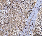 NR5A2 Antibody Urothelial Tumor IHC. Immunohistochemistry staining of FFPE human bladder urothelial carcinoma tissue using NR5A2 antibody reveals heterogeneous nuclear and cytoplasmic HRP-DAB brown staining in invasive malignant urothelial cell populations separated by fibrous stromal bands. The observed staining distribution is consistent with expression of NR5A2 / Liver receptor homolog 1 in tumor-associated epithelial signaling compartments involved in metabolic and proliferative transcriptional regulation. HIER: boil tissue sections in pH8 EDTA for 20 min and allow to cool before testing.