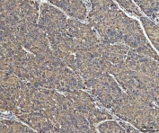 IHC staining of FFPE human liver cancer tissue with Acetyl-CoA acetyltransferase antibody. HIER: boil tissue sections in pH8 EDTA for 20 min and allow to cool before testing.