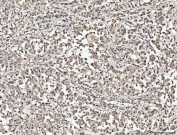 IHC staining of FFPE human lung cancer tissue with NUMA1 antibody. HIER: boil tissue sections in pH8 EDTA for 20 min and allow to cool before testing.