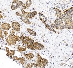 Nucleoporin 107 Antibody in Human Liver Cancer IHC. Immunohistochemistry analysis of FFPE human liver cancer tissue with Nucleoporin 107 Antibody / Nuclear Pore Complex Antibody at 2 ug/ml. Heat-induced epitope retrieval (HIER) was performed in EDTA buffer, pH 8.0, followed by blocking with 10% goat serum. The tissue was incubated with the primary antibody overnight at 4oC, followed by a peroxidase-conjugated goat anti-rabbit IgG secondary antibody for 30 min at 37oC and DAB detection. NUP107 staining is observed in the tumor cells. This Nucleoporin 107 Antibody demonstrates detection of NUP107 in human liver cancer tissue.