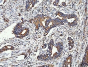 MMP19 Antibody Human Colorectal Adenocarcinoma IHC. Immunohistochemistry staining of FFPE human colorectal adenocarcinoma tissue using MMP19 antibody demonstrates strong cytoplasmic and membranous staining within malignant gland-forming epithelial cells, consistent with expression of Matrix Metalloproteinase 19 (MMP19). MMP19 is a tissue remodeling protein that regulates extracellular matrix turnover, cellular migration, and interactions between tumor cells and the surrounding microenvironment. The observed staining pattern is consistent with the established role of matrix metalloproteinases in extracellular matrix remodeling and tissue reorganization. These findings support the utility of MMP19 antibody for studies of tissue remodeling, extracellular matrix regulation, and tumor-associated cellular behavior. HIER: boil tissue sections in pH8 EDTA for 20 min and allow to cool before testing.
