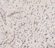 MMP19 Antibody Human Glioma IHC. Immunohistochemistry staining of FFPE human glioma tissue using MMP19 antibody demonstrates widespread cytoplasmic staining within neoplastic cells distributed throughout the tumor parenchyma, consistent with expression of Matrix Metalloproteinase 19 (MMP19). MMP19 is a tissue remodeling protein that regulates extracellular matrix turnover, cellular migration, and interactions between cells and the surrounding microenvironment. The observed staining pattern is consistent with the established role of matrix metalloproteinases in tissue reorganization and extracellular matrix regulation within complex cellular environments. These findings support the utility of MMP19 antibody for studies of tissue remodeling, extracellular matrix dynamics, and tumor-associated cellular behavior. HIER: boil tissue sections in pH8 EDTA for 20 min and allow to cool before testing.