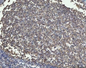 MMP19 Antibody Human Tonsil IHC. Immunohistochemistry staining of FFPE human tonsil using MMP19 antibody demonstrates widespread cytoplasmic staining throughout lymphoid cell populations, with particularly prominent immunoreactivity within germinal center-associated regions. Matrix Metalloproteinase 19 (MMP19) is a tissue remodeling protein that regulates extracellular matrix turnover, cellular migration, and interactions between immune cells and their surrounding microenvironment. The observed staining pattern is consistent with the established role of matrix metalloproteinases in tissue organization, extracellular matrix regulation, and dynamic remodeling processes within lymphoid tissues. These findings support the utility of MMP19 antibody for studies of tissue remodeling, extracellular matrix biology, and immune-associated cellular behavior. HIER: boil tissue sections in pH8 EDTA for 20 min and allow to cool before testing.