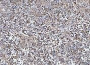 IHC staining of FFPE human testicular germ cell tumor tissue with TANGO1 antibody. HIER: boil tissue sections in pH8 EDTA for 20 min and allow to cool before testing.