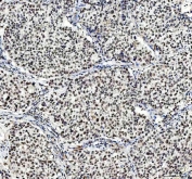 IHC staining of FFPE human liver cancer tissue with NCOA5 antibody. HIER: boil tissue sections in pH8 EDTA for 20 min and allow to cool before testing.