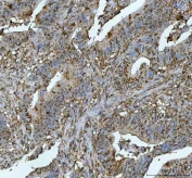 IHC staining of FFPE human colorectal adenocarcinoma tissue with NRMT antibody. HIER: boil tissue sections in pH8 EDTA for 20 min and allow to cool before testing.