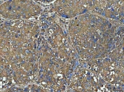 IHC staining of FFPE human liver cancer tissue with NT5C antibody. HIER: boil tissue sections in pH8 EDTA for 20 min and allow to cool before testing.