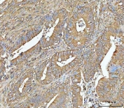IHC staining of FFPE human colorectal adenocarcinoma tissue with NT5C antibody. HIER: boil tissue sections in pH8 EDTA for 20 min and allow to cool before testing.