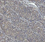NME6 Antibody Human Lung Cancer IHC. IHC staining of FFPE human lung cancer tissue was performed with NME6 Antibody at 2 ug/ml following heat-induced epitope retrieval in pH 8 EDTA buffer. HRP-conjugated secondary antibody and DAB were used for detection. NME6 staining is observed predominantly in the cytoplasm of tumor cells, with widespread staining across the cancer tissue. This NME6 Antibody demonstrates localization of Nucleoside Diphosphate Kinase 6 in human lung cancer tissue.