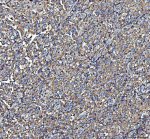 NME6 Antibody Human Spermatocytic Seminoma IHC. IHC staining of FFPE human spermatocytic seminoma testis tissue was performed with NME6 Antibody at 2 ug/ml following heat-induced epitope retrieval in pH 8 EDTA buffer. HRP-conjugated secondary antibody and DAB were used for detection. NME6 staining is observed predominantly in the cytoplasm of tumor cells, with widespread staining throughout the seminoma tissue. This NME6 Antibody demonstrates localization of Nucleoside Diphosphate Kinase 6 in human spermatocytic seminoma tissue.