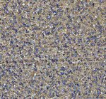 NME6 Antibody Human Glioblastoma IHC. IHC staining of FFPE human glioblastoma tissue was performed with NME6 Antibody at 2 ug/ml following heat-induced epitope retrieval in pH 8 EDTA buffer. HRP-conjugated secondary antibody and DAB were used for detection. NME6 staining is observed predominantly in the cytoplasm of glioblastoma cells, with diffuse staining throughout the tumor tissue. This NME6 Antibody demonstrates localization of Nucleoside Diphosphate Kinase 6 in human glioblastoma tissue.