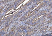 IHC staining of FFPE human colorectal adenocarcinoma tissue with PROSER3 antibody. HIER: boil tissue sections in pH8 EDTA for 20 min and allow to cool before testing.