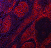 Immunofluorescence analysis of LYPD3 Antibody in human skin cancer tissue. Formalin-fixed, paraffin-embedded human skin cancer sections show strong membranous and peripheral cytoplasmic fluorescence consistent with Ly6/PLAUR domain-containing protein 3 (C4.4A / LYPD3) expression in tumor epithelial cells. LYPD3 antibody signal is visualized in red outlining malignant squamous epithelial cells, while nuclei are counterstained with DAPI (blue). Heat-induced epitope retrieval was performed by steaming tissue sections in pH 8 EDTA buffer for 20 min prior to antibody incubation.