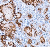 Immunohistochemistry of LYPD3 Antibody in human skin cancer tissue. Formalin-fixed, paraffin-embedded human skin cancer sections demonstrate membranous HRP-DAB brown staining outlining tumor epithelial cells consistent with Ly6/PLAUR domain-containing protein 3 (C4.4A / LYPD3) expression. Positive staining highlights nests of malignant squamous epithelial cells, while surrounding stromal components show minimal signal. Heat-induced epitope retrieval was performed by boiling tissue sections in pH 8 EDTA buffer for 20 min followed by cooling prior to antibody incubation.