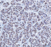 IHC staining of FFPE human lung adenocarcinoma tissue with ATG7 antibody. HIER: boil tissue sections in pH8 EDTA for 20 min and allow to cool before testing.