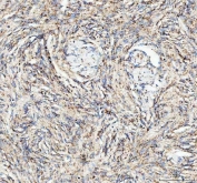 IHC staining of FFPE human meningioma tissue with ATG7 antibody. HIER: boil tissue sections in pH8 EDTA for 20 min and allow to cool before testing.