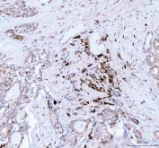 J Chain Antibody Thyroid Cancer IHC. Immunohistochemistry of FFPE human thyroid carcinoma tissue using J Chain antibody shows focal HRP-DAB brown cytoplasmic staining in scattered immune-associated cell populations within the tumor microenvironment, consistent with JCHAIN / IGJ expression in plasma cell-associated secretory immunoglobulin-producing cells. HIER: boil tissue sections in pH8 EDTA for 20 min and allow to cool before testing.