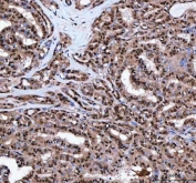 IHC staining of FFPE human thyroid papillary carcinoma tissue with Leukotriene A-4 hydrolase antibody. HIER: boil tissue sections in pH8 EDTA for 20 min and allow to cool before testing.