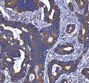 IHC staining of FFPE human colorectal adenocarcinoma tissue with DAPK1 antibody. HIER: boil tissue sections in pH8 EDTA for 20 min and allow to cool before testing.