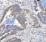 IHC staining of FFPE human colorectal adenocarcinoma tissue with Amyloid-like protein 2 antibody. HIER: boil tissue sections in pH8 EDTA for 20 min and allow to cool before testing.