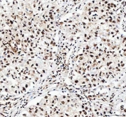 IHC staining of FFPE human lung cancer tissue with ILF2 antibody. HIER: boil tissue sections in pH8 EDTA for 20 min and allow to cool before testing.