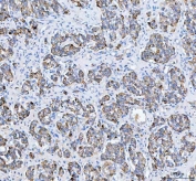 IHC staining of FFPE human lung adenocarcinoma tissue with Pellino-3 antibody. HIER: boil tissue sections in pH8 EDTA for 20 min and allow to cool before testing.