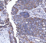 LRRN4 Antibody Ovarian Carcinoma IHC. Immunohistochemistry staining of FFPE human ovarian carcinoma tissue with LRRN4 Antibody / Cancer-Associated LRR Protein Antibody demonstrates diffuse cytoplasmic and membranous HRP-DAB brown staining in malignant epithelial cells, consistent with carcinoma-associated expression of Leucine rich repeat neuronal protein 4 / LRRN4 in ovarian tumor tissue. HIER: boil tissue sections in pH8 EDTA for 20 min and allow to cool before testing.