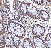LRRN4 Antibody Colorectal Adenocarcinoma IHC. Immunohistochemistry staining of FFPE human colorectal adenocarcinoma tissue with LRRN4 Antibody / Cancer-Associated LRR Protein Antibody demonstrates predominantly apical and cytoplasmic HRP-DAB brown staining in malignant gland-forming epithelial cells, supporting expression of Leucine rich repeat neuronal protein 4 / LRRN4 in gastrointestinal carcinoma-associated cellular populations. HIER: boil tissue sections in pH8 EDTA for 20 min and allow to cool before testing.