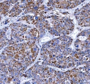 LRRN4 Antibody Liver Cancer IHC. Immunohistochemistry staining of FFPE human liver cancer tissue with LRRN4 Antibody / Cancer-Associated LRR Protein Antibody demonstrates diffuse cytoplasmic HRP-DAB brown staining in malignant hepatic tumor cells with focal membranous accentuation, consistent with carcinoma-associated expression of Leucine rich repeat neuronal protein 4 / LRRN4 in liver malignancy tissue. HIER: boil tissue sections in pH8 EDTA for 20 min and allow to cool before testing.
