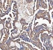 IHC staining of FFPE human ovarian serous adenocarcinoma tissue with PAIP1 antibody. HIER: boil tissue sections in pH8 EDTA for 20 min and allow to cool before testing.