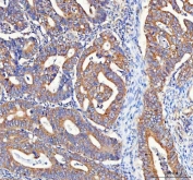 IHC staining of FFPE human rectum adenocarcinoma tissue with PAIP1 antibody. HIER: boil tissue sections in pH8 EDTA for 20 min and allow to cool before testing.