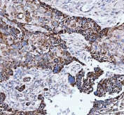 IHC staining of FFPE human esophageal squamous carcinoma tissue with IARS2 antibody. HIER: boil tissue sections in pH8 EDTA for 20 min and allow to cool before testing.