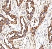 IHC staining of FFPE human pancreas ductal adenocarcinoma tissue with ITPA antibody. HIER: boil tissue sections in pH8 EDTA for 20 min and allow to cool before testing.
