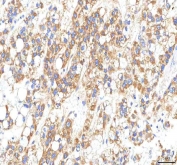 IHC staining of FFPE human liver cancer tissue with OMI antibody. HIER: boil tissue sections in pH8 EDTA for 20 min and allow to cool before testing.