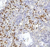S100A12 Antibody Rabbit Polyclonal in human spleen tissue. Immunohistochemistry staining of FFPE human spleen demonstrates cytoplasmic staining in numerous scattered inflammatory cells consistent with the known expression of S100 calcium binding protein A12 / S100A12 in neutrophils and other myeloid-derived cells. Brown chromogenic signal highlights S100A12-positive inflammatory cells within splenic tissue while surrounding lymphoid populations remain largely negative. Heat-induced epitope retrieval was performed by boiling tissue sections in pH 8 EDTA buffer for 20 min before staining.