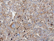 CD206 Antibody Human Liver Cancer IHC. Immunohistochemical staining of FFPE human liver cancer tissue using CD206 Antibody / Macrophage Mannose Receptor Antibody demonstrates widespread cytoplasmic and membranous HRP-DAB brown staining throughout the tumor microenvironment, including scattered immune cell populations and stromal-associated elements. The staining pattern is consistent with expression of CD206 (MRC1), a C-type lectin receptor involved in carbohydrate recognition, receptor-mediated endocytosis, antigen processing, and macrophage-mediated immune regulation. Positive immunoreactivity is compatible with tumor-associated macrophages and other antigen-presenting cell populations that contribute to immune modulation, tissue remodeling, and cellular communication within the hepatic tumor microenvironment. HIER: boil tissue sections in pH8 EDTA for 20 min and allow to cool before testing.
