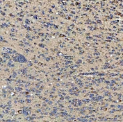 IHC staining of FFPE human glioblastoma tissue with GlnRS antibody. HIER: boil tissue sections in pH8 EDTA for 20 min and allow to cool before testing.