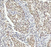 TARDBP Antibody Colorectal Adenocarcinoma Immunohistochemistry. IHC staining of FFPE human colorectal adenocarcinoma tissue with TARDBP antibody. HIER: boil tissue sections in pH8 EDTA for 20 min and allow to cool before testing.