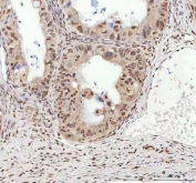 TARDBP Antibody Ovarian Cancer Immunohistochemistry. staining of FFPE human ovarian cancer tissue with TARDBP antibody. HIER: boil tissue sections in pH8 EDTA for 20 min and allow to cool before testing.