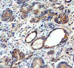 MRPS31 Antibody 29M40 in Human Stomach Cancer IHC. Immunohistochemistry staining of FFPE human stomach cancer tissue with MRPS31 Antibody 29M40 / Mitochondrial Ribosomal Protein S31 Antibody, clone 29M40, at 1:50 overnight at 4oC. HIER was performed using EDTA buffer, pH 8.0, followed by blocking with 10% goat serum. HRP/DAB detection demonstrates MRPS31 staining in human stomach cancer tissue.